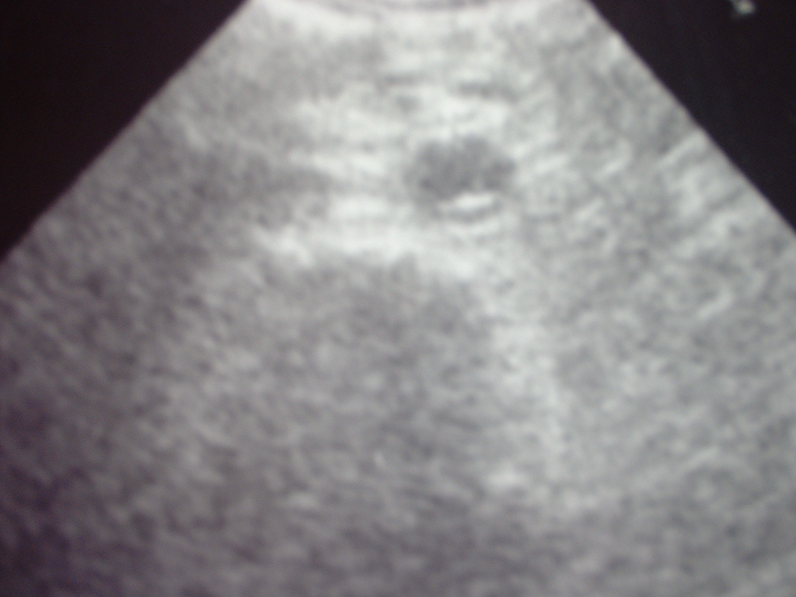 Aortic disection in abdomen.jpg