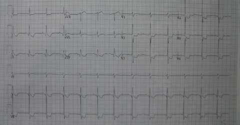 ekg