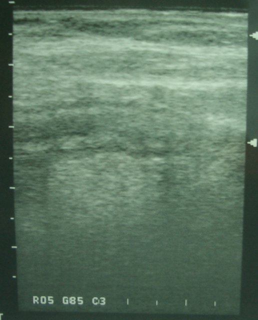 appendicitis ultrasound