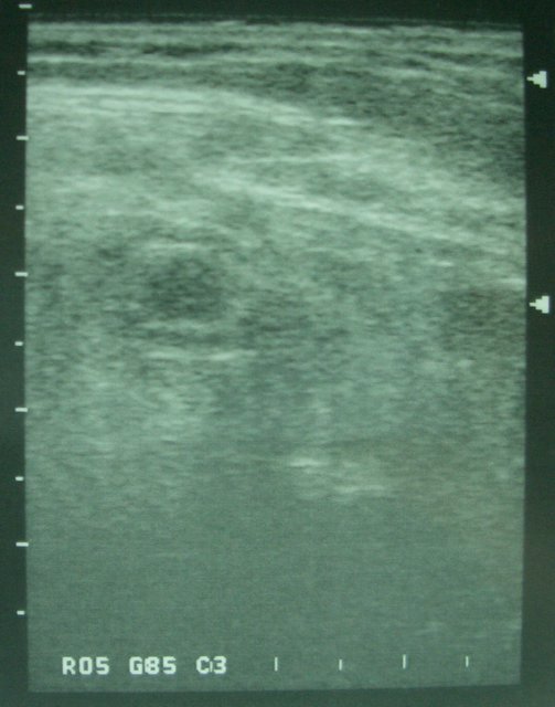 appendicitis transverse