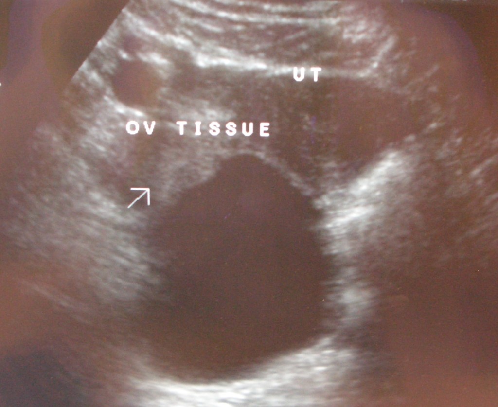 Ovarian Torsion, Labelled 2