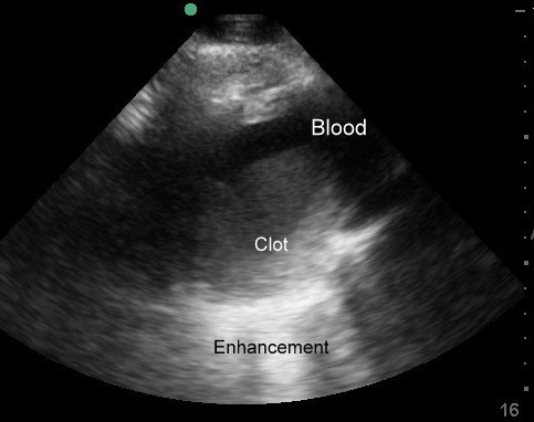 Uterine Cervical Stenosis 2 Labelled