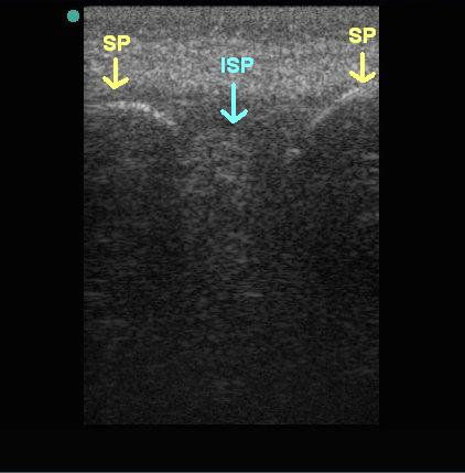 ultrasound-guided-lp2.jpg