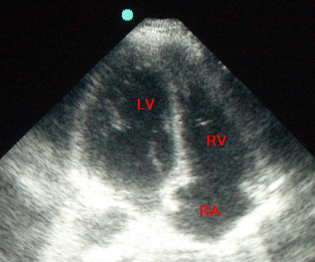 echo-normal-heart-labeled.JPG