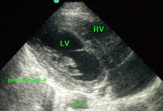 echo-normal-heart-parasternal-view.JPG