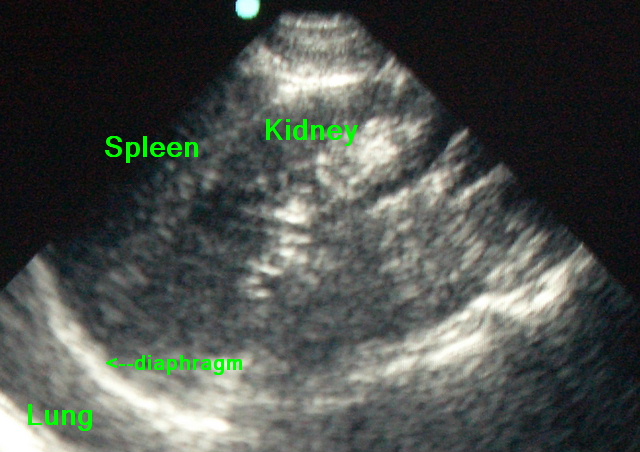 ultrasound-normal-abdomen-luq.JPG