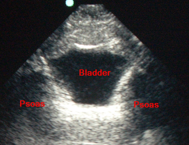 ultrasound-normal-bladder-labelled.JPG