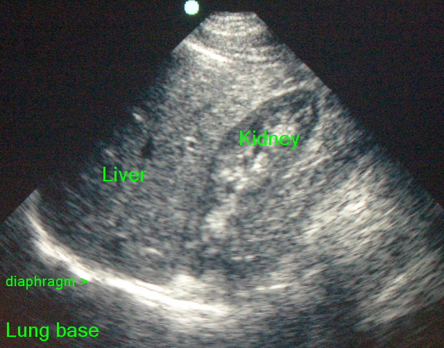 ultrasound-normal-ruq-abdomen.JPG