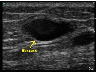 ultrasound-abscess.jpg