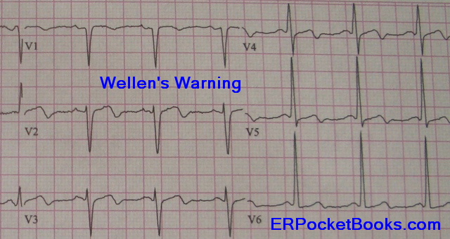 wellens-warning.jpg