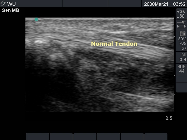 flexor pollicis longus. flexor pollicis longus. Normal Tendon: Flexor Pollicis; Normal Tendon: Flexor Pollicis. Electro Funk. Oct 28, 10:06 PM. They may think it#39;s cracked,