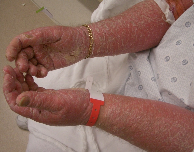 Vancomycin Rash