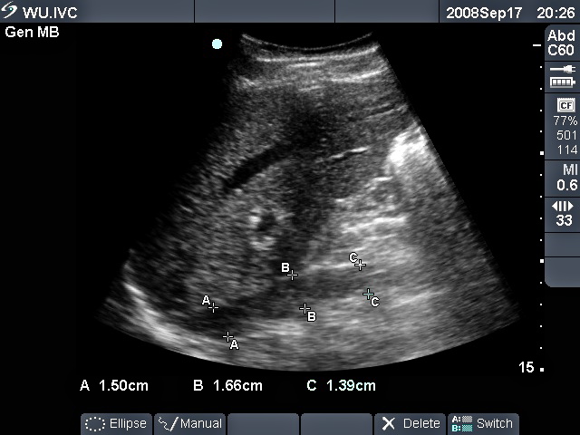 ivc-with-label-for-epm.jpeg