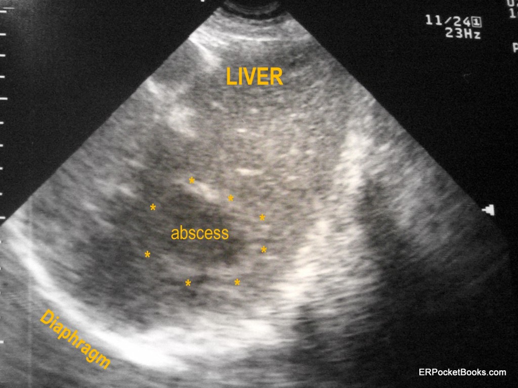 2 - Liver Abscess labelled