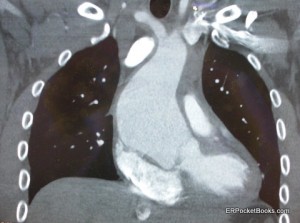 Aortic Aneurysm CT