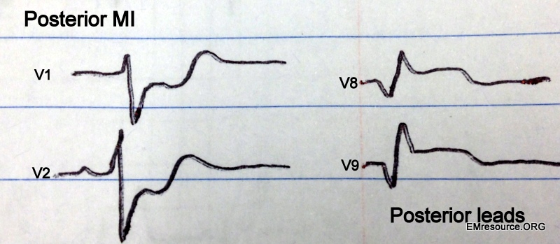 Posterior MI