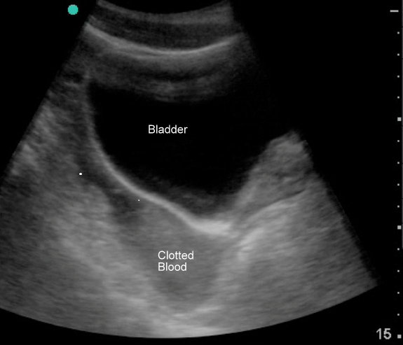 Clotted Pelvic Free Fluid