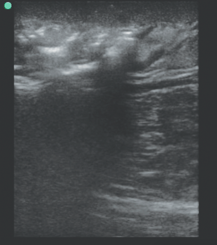 Nec Fasc ultrasound