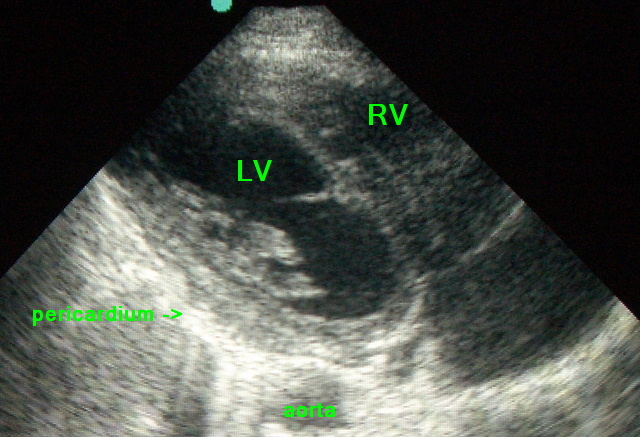 echo-normal-heart-parasternal-view.JPG